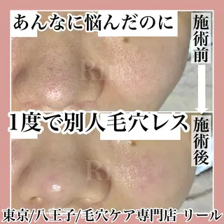 毛穴特化エステ -リールのエステ・リラクイメージ