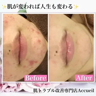 ショート カラー パーマ ヘアアレンジ メンズ キッズ ネイル マツエク・マツパ アイブロウ ニキビ・肌質改善専門 ♡人生が変わるサロンのエステ・リラクイメージ
