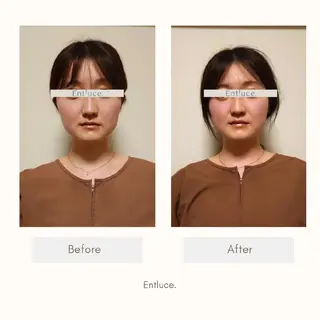 即効⚡小顔美容鍼🪡 むくみたるみケア鍼!のエステ・リラクイメージ