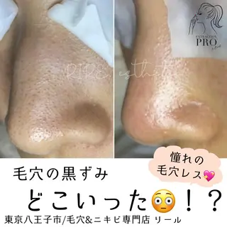 毛穴特化エステ -リールのエステ・リラクイメージ
