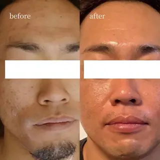 毛穴•肌質改善 EARNEST心斎橋のエステ・リラクイメージ