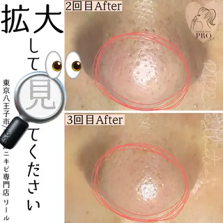 毛穴特化エステ -リールのエステ・リラクイメージ
