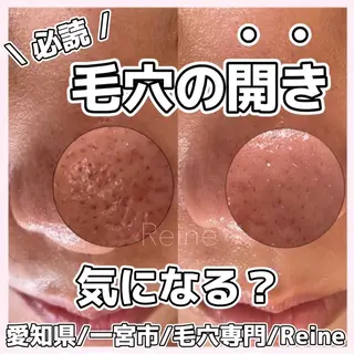 毛穴/シミ肝斑/脱毛 横山梨里のエステ・リラクイメージ