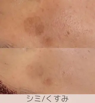 小顔/毛穴/ニキビ salon bealのエステ・リラクイメージ
