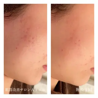 ミディアム カラー パーマ ヘアアレンジ メンズ キッズ ネイル マツエク・マツパ ニキビ跡専門サロン Ａｉｎａのエステ・リラクイメージ