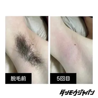 メンズ メンズ脱毛JAPAN 東広島店🇯🇵のエステ・リラクイメージ