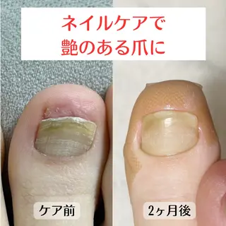 ネイル 巻き爪・肥厚爪ケア 専門サンセリテのネイルデザイン