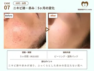 ニキビケア・毛穴専門 mele|もりぞののエステ・リラクイメージ
