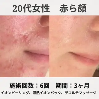 ニキビ跡改善専門🔥 医療にはできない改善のエステ・リラクイメージ