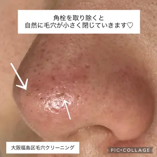 毛穴ケア・肌質改善 徳川のエステ・リラクイメージ