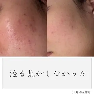 ニキビ経験者が施術 する専門サロン🌻のエステ・リラクイメージ