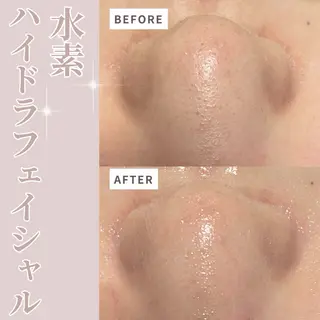 水素ハイドラ/脱毛 /ハーブピーリングのエステ・リラクイメージ