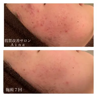 ミディアム カラー パーマ ヘアアレンジ メンズ キッズ ネイル マツエク・マツパ ニキビ跡専門サロン Ainaのエステ・リラクイメージ