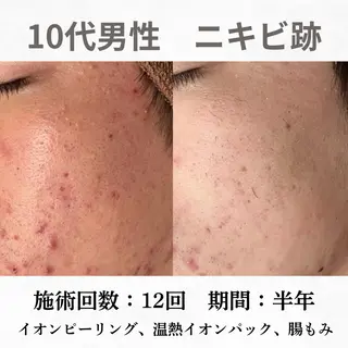 重度ニキビ専門🌼 ダウンタイムなしのエステ・リラクイメージ