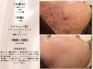 何をしても繰り返す ニキビ・ニキビ跡専門のエステ・リラクイメージ
