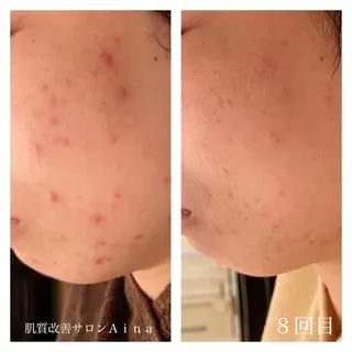 セミロング カラー パーマ ヘアアレンジ メンズ キッズ ネイル マツエク・マツパ ニキビ跡専門サロン Ainaのエステ・リラクイメージ