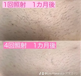 毛穴洗浄🍀脱毛🍀 光フェイシャル🍀のエステ・リラクイメージ