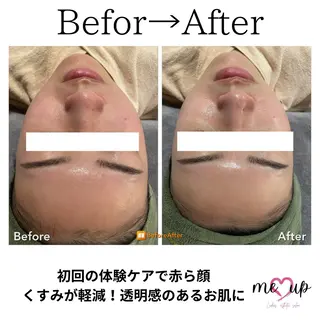 Meupニキビ専門店 背中/ハーブ/肌管理のその他イメージ