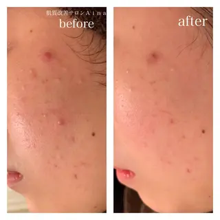 セミロング カラー パーマ ヘアアレンジ メンズ ネイル マツエク・マツパ ニキビ跡専門サロン Ainaのエステ・リラクイメージ