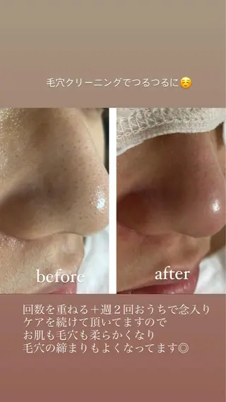毛穴ケア・肌質改善 徳川のエステ・リラクイメージ