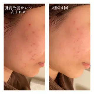 ミディアム カラー パーマ ヘアアレンジ メンズ キッズ ネイル マツエク・マツパ ニキビ跡専門サロン Ainaのエステ・リラクイメージ
