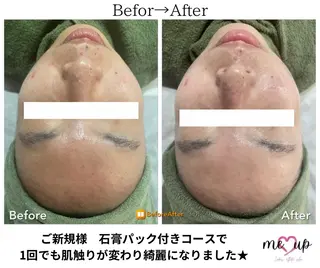 Meupニキビ専門店 背中/ハーブ/肌管理のその他イメージ