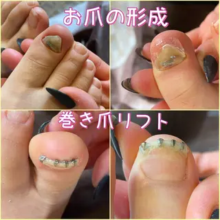ネイル ♢ME2ROOM♢ #巻き爪#リラクのネイルデザイン