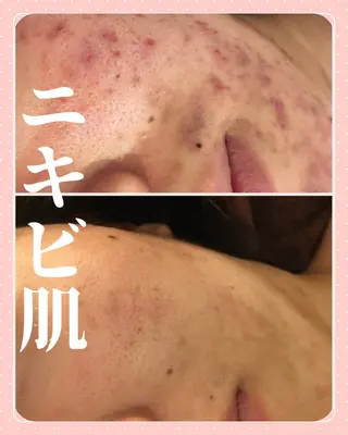 ニキビ・敏感肌専門 サロン/横田のエステ・リラクイメージ