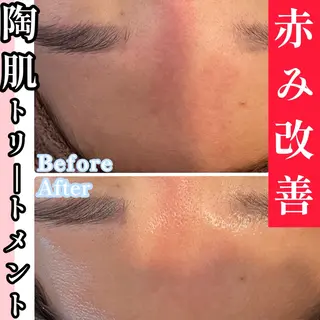 韓国肌管理🫧艶肌 ニキビケア🩵本町店のエステ・リラクイメージ
