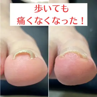 ネイル 巻き爪・肥厚爪ケア 専門サンセリテのネイルデザイン