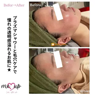 Meupニキビ専門店 背中/ハーブ/肌管理のその他イメージ