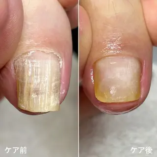 ネイル 深爪・巻き爪 専門サンセリテのネイルデザイン