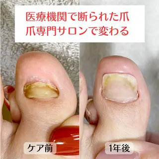 ネイル 巻き爪・肥厚爪ケア 専門サンセリテのネイルデザイン