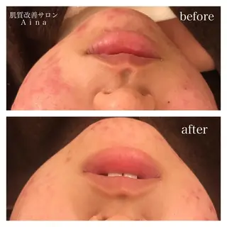 セミロング カラー パーマ ヘアアレンジ メンズ キッズ ネイル マツエク・マツパ ニキビ跡専門サロン Ainaのエステ・リラクイメージ