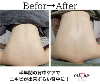 Meupニキビ専門店 背中/ハーブ/肌管理のその他イメージ