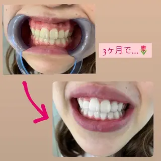nene -ホワイトニングのその他イメージ