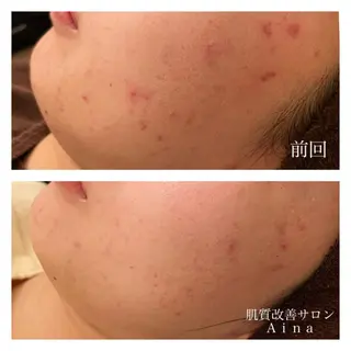 セミロング カラー パーマ ヘアアレンジ メンズ キッズ ネイル マツエク・マツパ ニキビ跡専門サロン Ainaのエステ・リラクイメージ