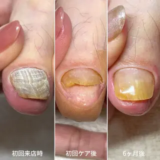 ネイル 深爪・巻き爪 専門サンセリテのネイルデザイン