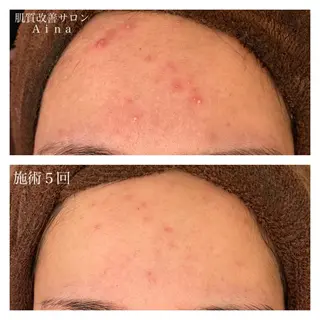 ロング カラー パーマ ヘアアレンジ メンズ キッズ ネイル マツエク・マツパ ニキビ跡専門サロン Ainaのエステ・リラクイメージ
