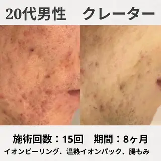ニキビ跡改善専門🔥 医療にはできない改善のエステ・リラクイメージ