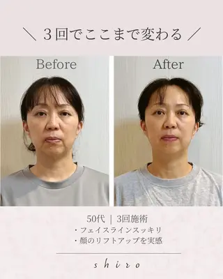 小顔矯正勝山式 shiroしろのエステ・リラクイメージ