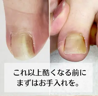 ネイル 巻き爪・肥厚爪ケア 専門サンセリテのネイルデザイン