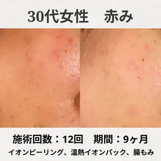 繰り返すニキビ跡専門 根本改善のエステ・リラクイメージ