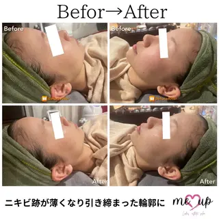 Meupニキビ専門店 背中/ハーブ/肌管理のその他イメージ