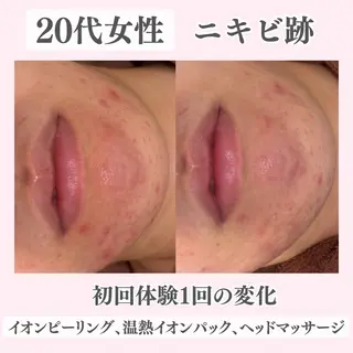ニキビ・肌質改善専門 ♡人生が変わるサロンのエステ・リラクイメージ