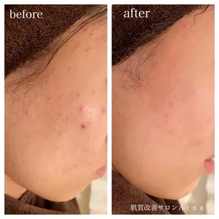 セミロング カラー パーマ ヘアアレンジ メンズ キッズ ネイル マツエク・マツパ ニキビ跡専門サロン Ainaのエステ・リラクイメージ