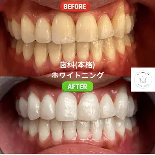 東区香椎歯のセルフホ ワイトニングGLOWのその他イメージ