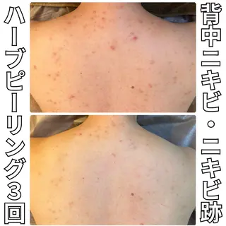 ニキビ・ニキビ跡改善 leoloのエステ・リラクイメージ