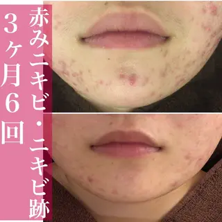 ミディアム カラー パーマ ヘアアレンジ メンズ キッズ ネイル マツエク・マツパ アイブロウ ニキビ・肌質改善専門 ♡人生が変わるサロンのエステ・リラクイメージ