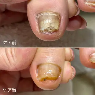 ネイル 深爪・巻き爪 専門サンセリテのネイルデザイン